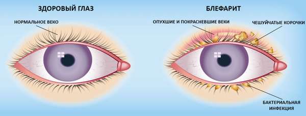 отличия блефарита от здорового глаза